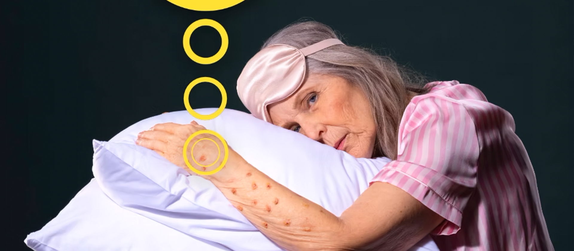 hero_PrurigoNodularis